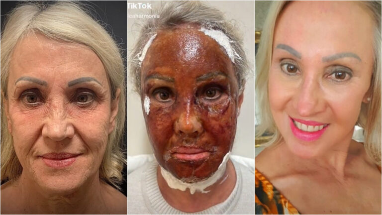Técnica Peeling de fenol modifica face de mulher