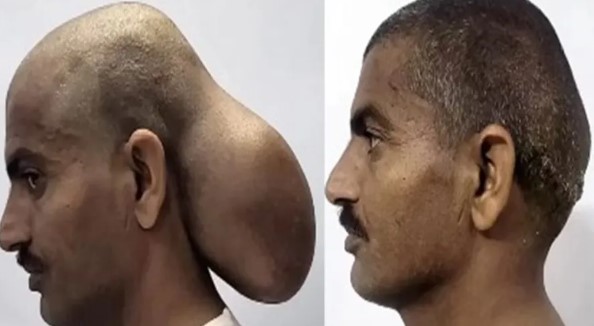 Indiano tinha um tumor na parte traseira da cabeça, com 20 centímetros de diâmetro